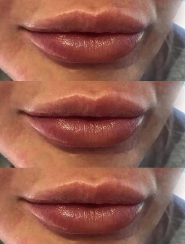 lip fillers 6