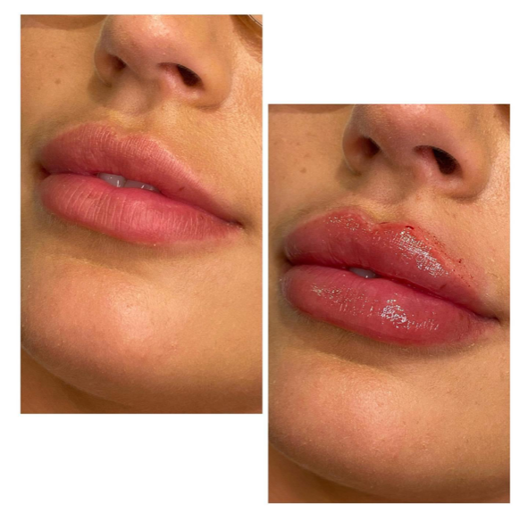 lip fillers2